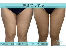 リメイククリニカルビューティー(Remake clinical beauty)/内腿に隙間を！