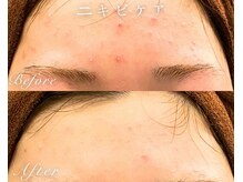ソワ(SOWA)/ニキビケア