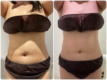 イデアルミー 大宮店(イデアルMe)/1回目施術Before after