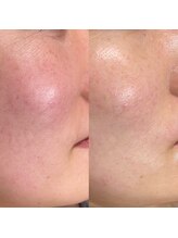 シロ(siro)/韓国水光肌・美白フェイスWax