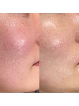 シロ(siro)/韓国水光肌・美白フェイスWax