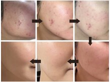 アイル 天王寺店(iru)/剥離ありハーブピーリング5回目