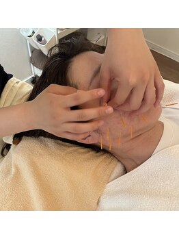 さくら治療院くまもと/年齢の幅が広く人気の美容鍼