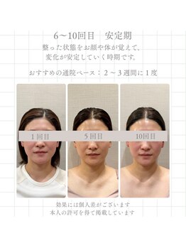 ナツメ鍼灸院(natume鍼灸院)/通い方 6~10回目 安定期