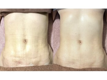 サロン タエン/ウエスト／術後インディバ