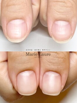 マリーロール 梅田店(Marie Laure)/自爪育成/深爪矯正/ネイルケア
