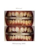 リトリート(Retreat)/ホワイトニング【3回ご来店】