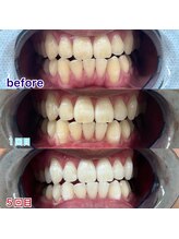 キラット 栃木店(Kiratt)/クリスタルセルフホワイトニング