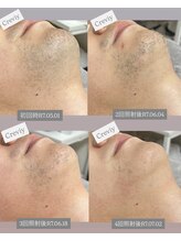 クレヴィー(Creviy)/ヒゲ脱毛4回照射までの経過