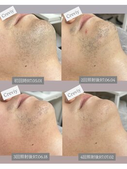 クレヴィー(Creviy)/ヒゲ脱毛4回照射までの経過