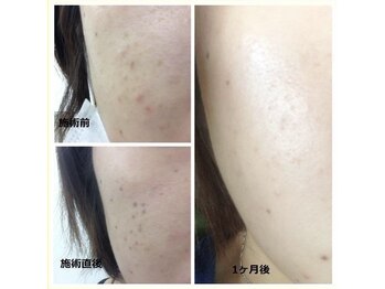 セゾン(Saison)/シミケア施術前後