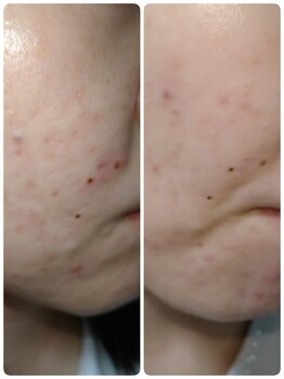 ラ ナチュール(La Nature)/20代 毛穴洗浄(肌悩み)