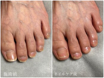 フットネイルケア/欠けやすい爪