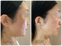 バービーフェイス 恵比寿(Barbie Face)/毛穴引き締め 透明感&ハリツヤUP