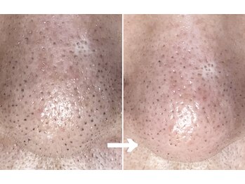 カミーシャ(KaMi-Sha)/【50代女性】1回施術症例写真