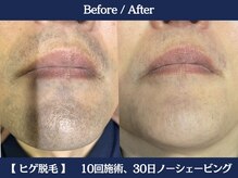 ランドマーク 中崎町(LANDMARK.)/《 鼻下・口下・あご 》