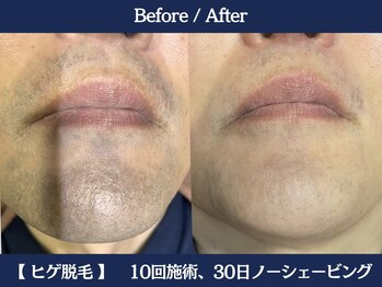 ランドマーク 中崎町(LANDMARK.)/《 鼻下・口下・あご 》