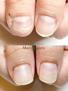 マリーロール 梅田店(Marie Laure)/自爪育成/深爪矯正/ネイルケア