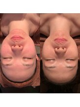 ルーチェ(Luce)/ハーブピーリング