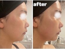 エヴァル 久留米店(ewalu)/温熱小顔リフト