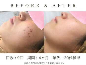 ロエヴェ(ROEWE)/ニキビ改善・毛穴ケア・肌質改善