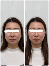 ラフテル鍼灸整骨院/美容鍼で結婚式前のメンテナンス