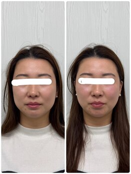 ラフテル鍼灸整骨院/美容鍼で結婚式前のメンテナンス