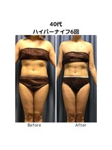 ビハダエステ 町田店(BIHADAエステ)/【B/A】40代ハイパーナイフ