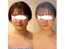 ボディスタイリング(Body Styling)の雰囲気（エレクトロハンドフェイシャルでほうれい線タルミトトーンアップ）