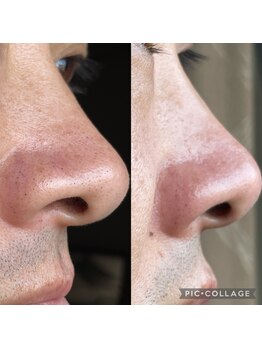 トータルクリア(TOTAL CLEAR)/美容液で洗う毛穴洗浄