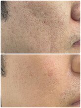 ユフラ(Juhla)/韓国式ハーブピーリング