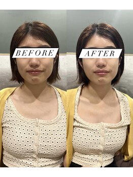 シロ(silo.)/幹細胞導入フェイシャル＋パック