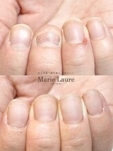 マリーロール 梅田店(Marie Laure)/自爪育成/深爪矯正/ネイルケア