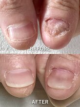 ポメロ(POMELO)/凹凸深爪でも深爪矯正出来ます