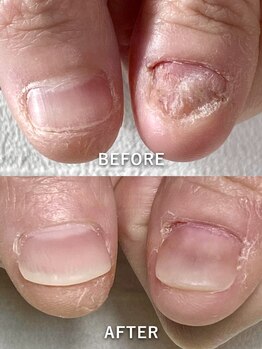 ポメロ(POMELO)/凹凸深爪でも深爪矯正出来ます