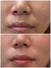 ナナプラス(nana plus)/毛穴ケア