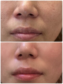 ナナプラス(nana plus)/毛穴ケア