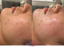 クレヴィア バイ サイバーエステ(CREBIA)/デトックス【ビオフィート】