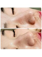 庭夢エステ/いちご鼻改善｜毛穴洗浄＋IPL(光