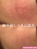 【8/19限定ゲリラクーポン】肌質改善メニュー新規価格から2,000引(背中or顔)