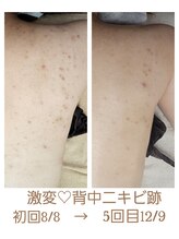 リブラン(Libran)/【魅せる肌へ】背中ケアコース