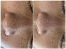 ラヴィ(Ravi)/一度の施術効果