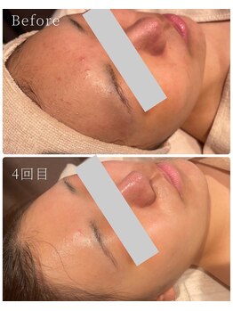 ウルソワン 都島店(/ulu soin)/ニキビ改善4回