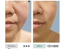 ジェニックサロン グランギンザ 水戸(GENIC SALON GRAND GINZA)/最新リフトアップ/水戸/たるみ