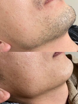 アイラッシュサロン ドール(Doll)/【メンズ】ヒゲ脱毛