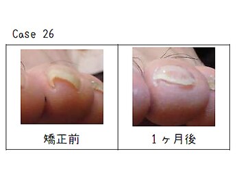 東京巻き爪センター 本院 麻布十番/施術例[巻き爪/東京/麻布十番]