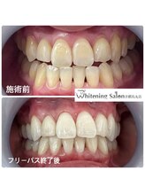 ホワイトニングサロン 京都烏丸店/ホワイトニング施術例