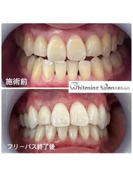 ホワイトニングサロン 京都烏丸店/ホワイトニング施術例