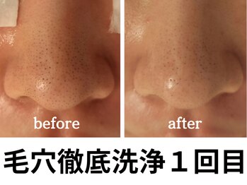 エリン(ERIN)/毛穴徹底洗浄