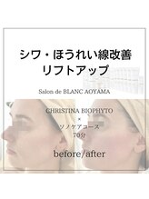 サロン ド ブラン アオヤマ(Salon de BLANC AOYAMA)/シワ改善&ほうれい線改善
